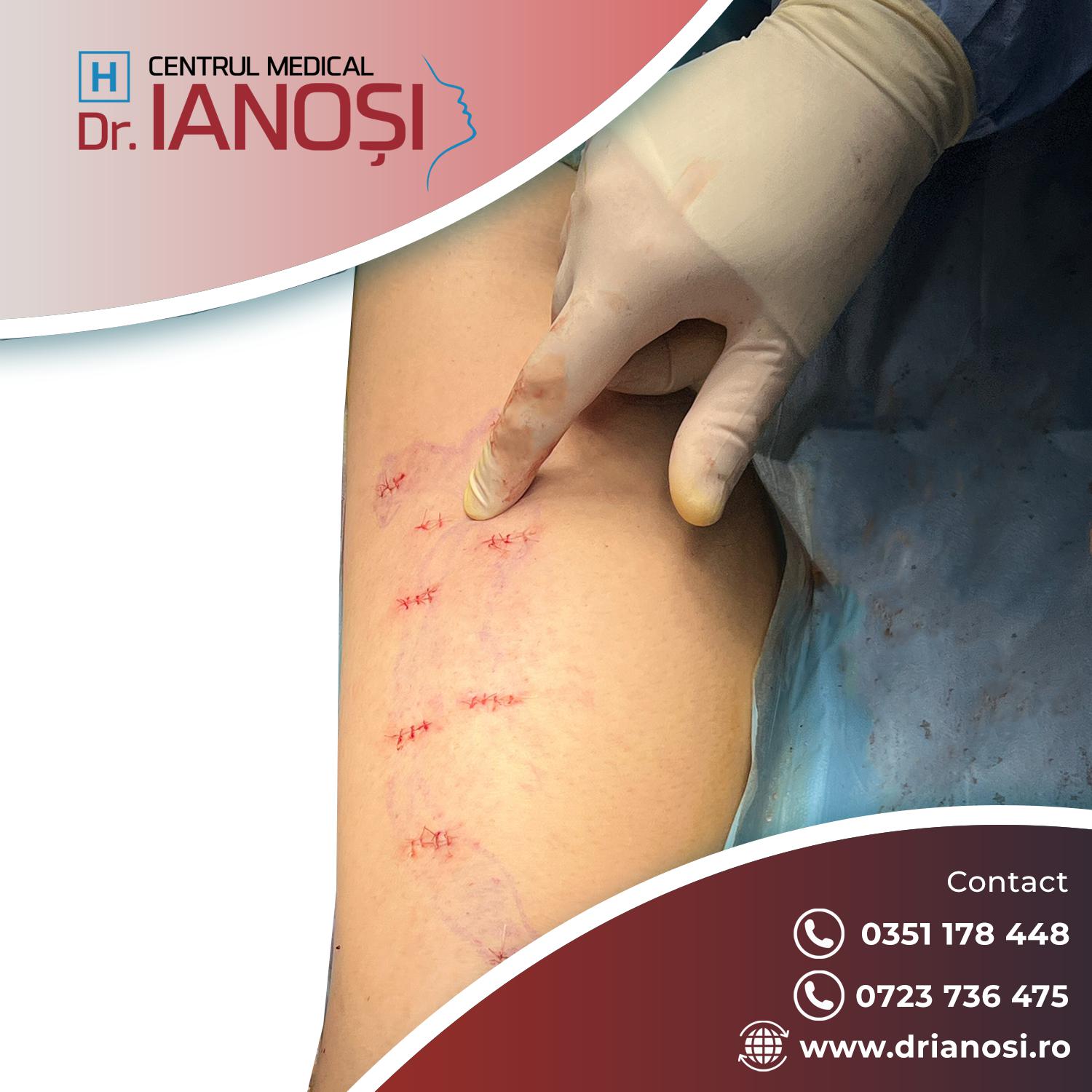 Tratament complet și complex al varicelor img.1